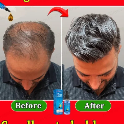 2025 Latest Hair Growth Technology | Stimulates Hair, Beard & Chest Hair Growth | Eliminates Baldness Effectively